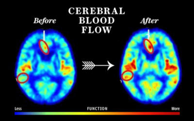 Alzheimer’s HBOT
